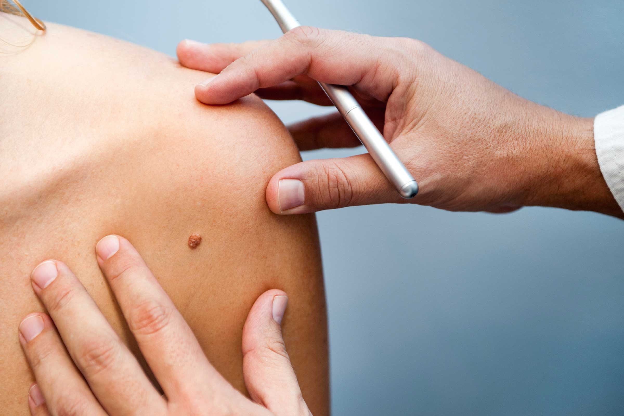 Doctor examining a mole on a person's shoulder.