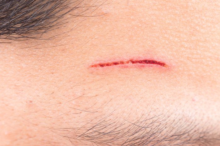 close up of a scrape above an eyebrow