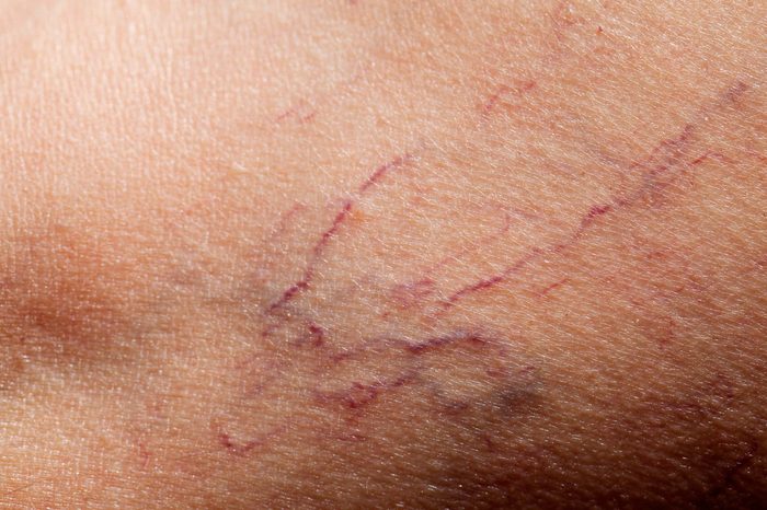 close up of spider veins, or telangiectasia, which are tiny thread-like veins