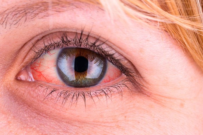 close up of yellowed eye