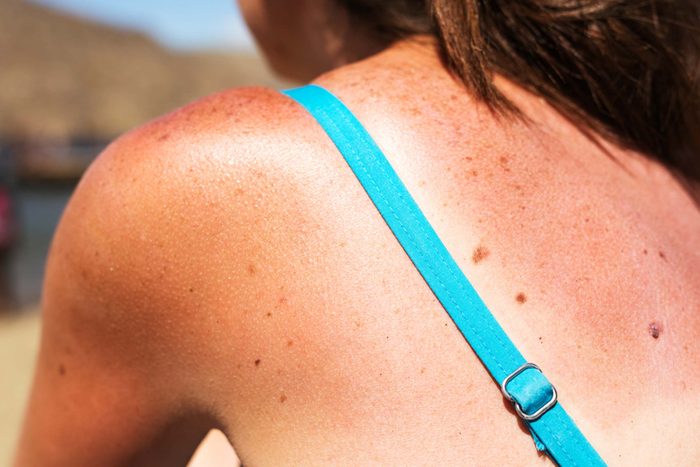 woman with sunburn