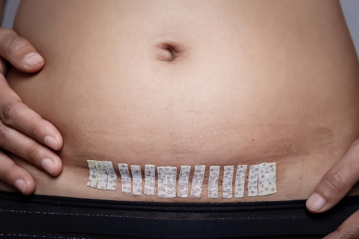 scar in abdomen