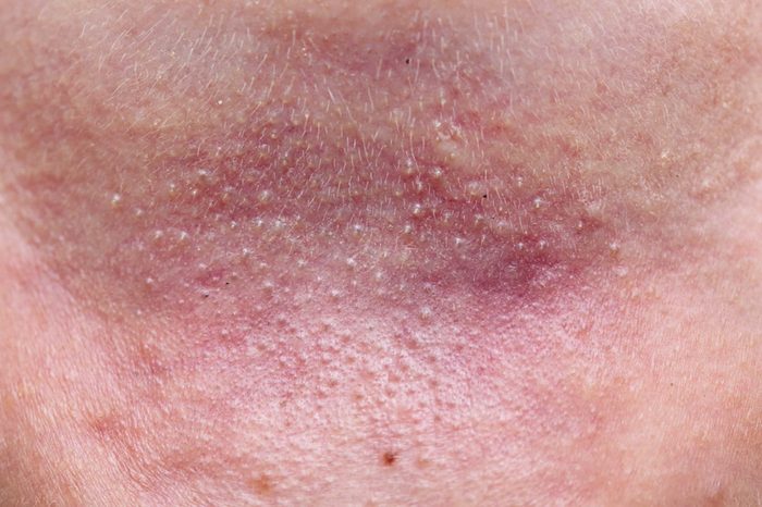 closeup of heat rash