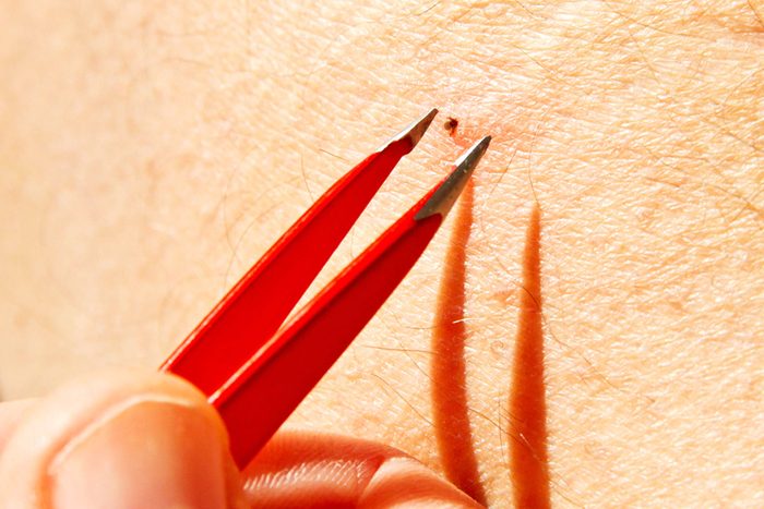 Tweezers and a tick