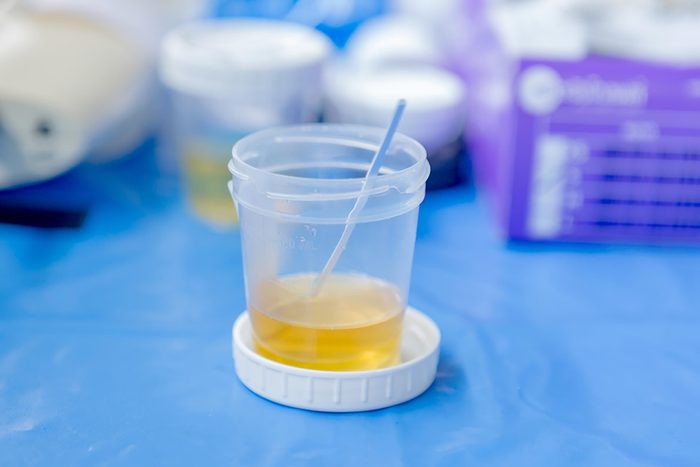 Cup of urine