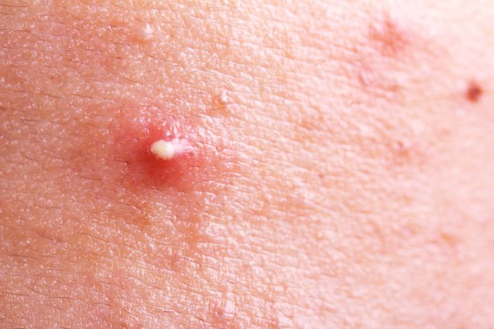 white head pimple