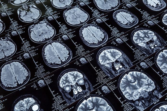 MRI scan