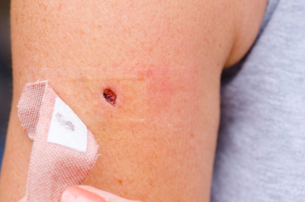 closeup of bite or wound