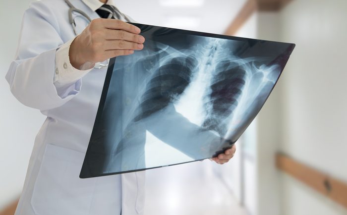 doctor checking chest x-ray film at ward hospital.