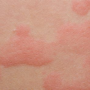 Close up Allergy rash, Around Back view of human with dermatitis problem of rash ,Allergy rash and Health problem.