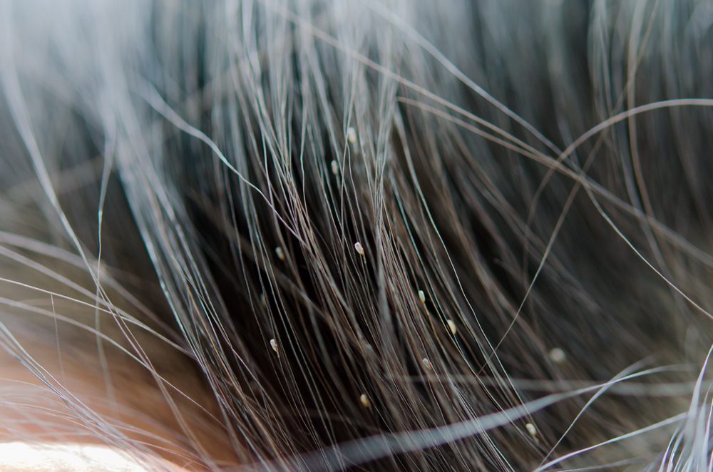Louse egg on the hair causes itchy head.