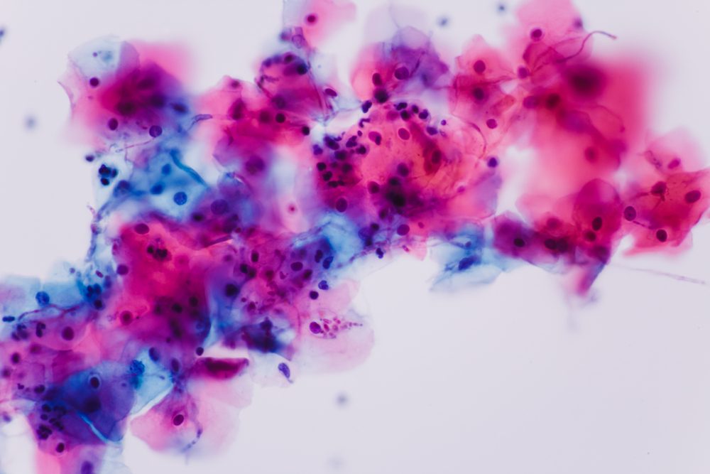 View in microscopic of Candidiasis, fungus infection 