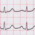 6 Warning Signs You May Be at Risk for Cardiac Arrest