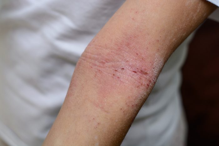 Dermatitis.