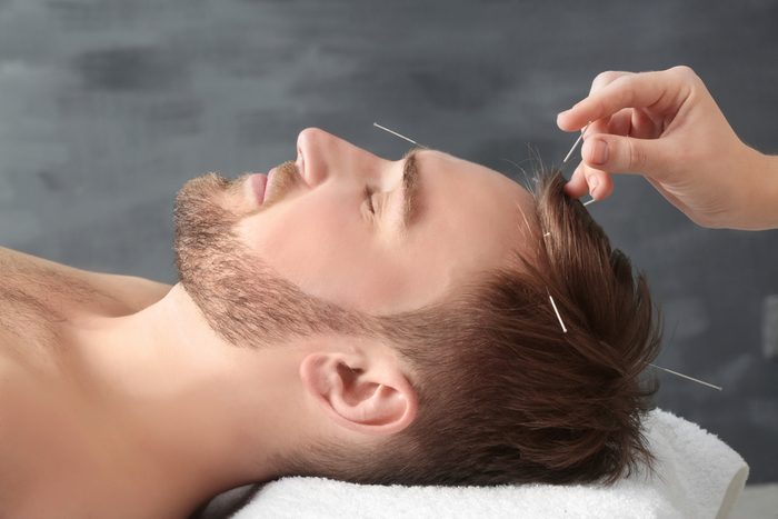 Young man getting acupuncture treatment, closeup