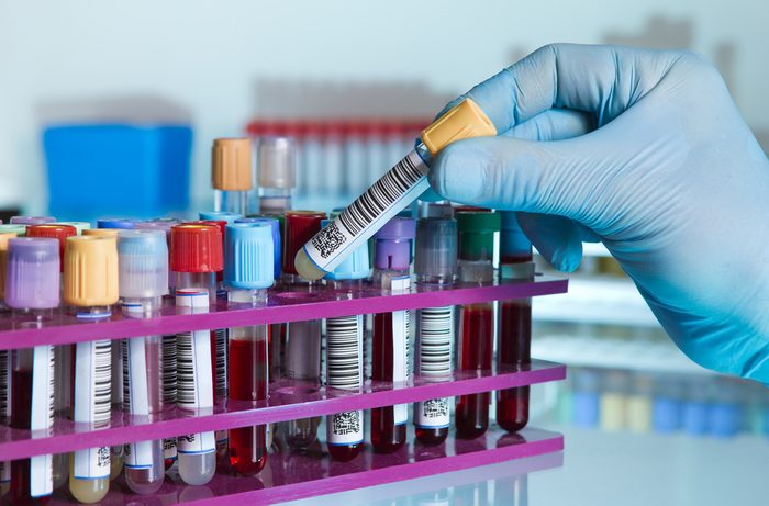 hand of a lab technician taking a tube of blood from a rack and the background color tubes with samples from other patients/ hand of laboratory technician holding a blood tube for analysis