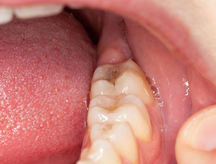 Close up macro shot of interior of mouth and fillings and crowns on teeth