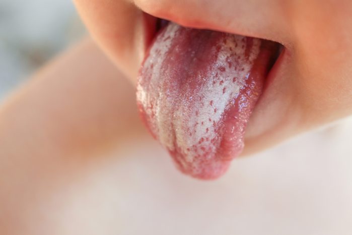 White coating on tongue baby. Oral thrush.