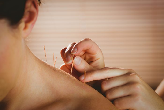 Young woman getting acupuncture treatment