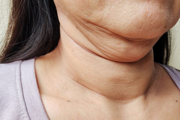 Double Chin