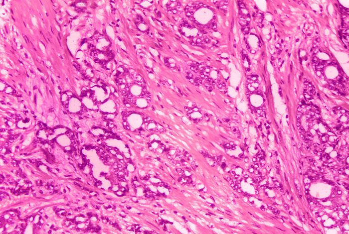 Prostate Cancer