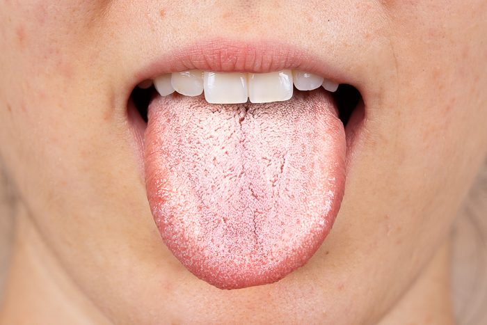 white patches on tongue