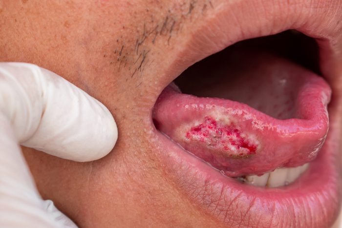 oral cancer