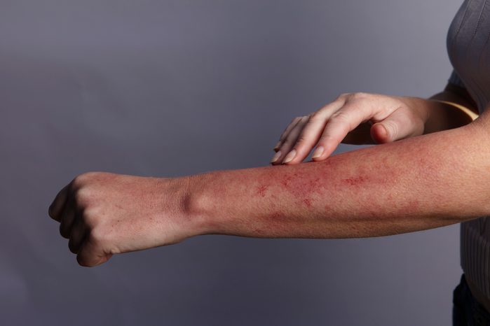 Hand feeling rash on arm