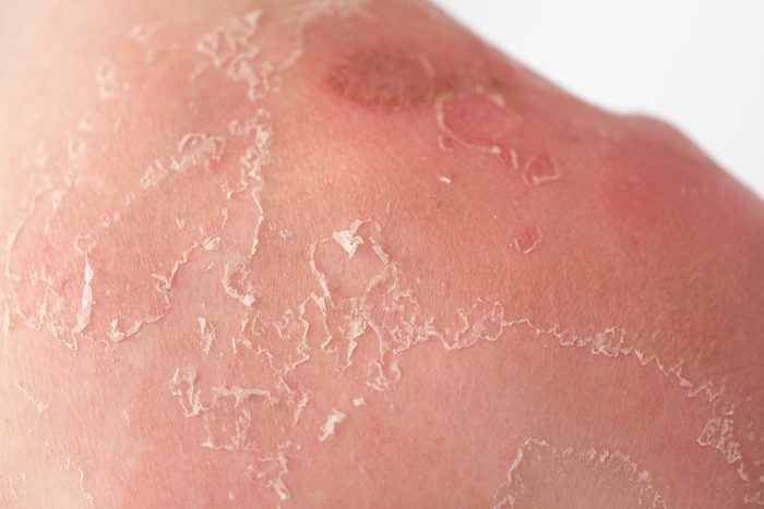 Sunburn