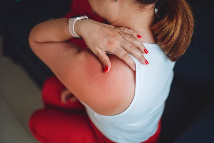 Close-up of a sunburn marks on a woman's back