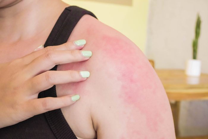 Sunburned Skin