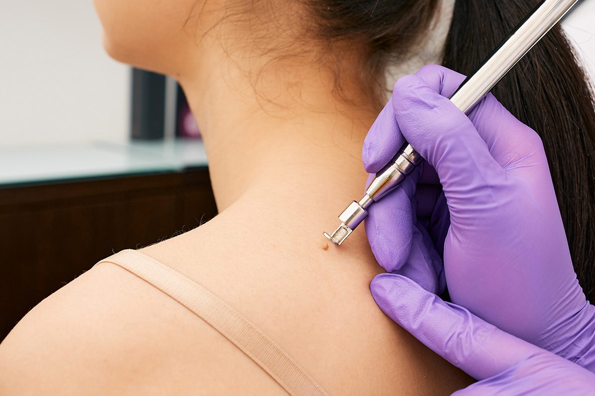 How To Get Rid Of Skin Tags The Right Way, Gettyimages 1310715651