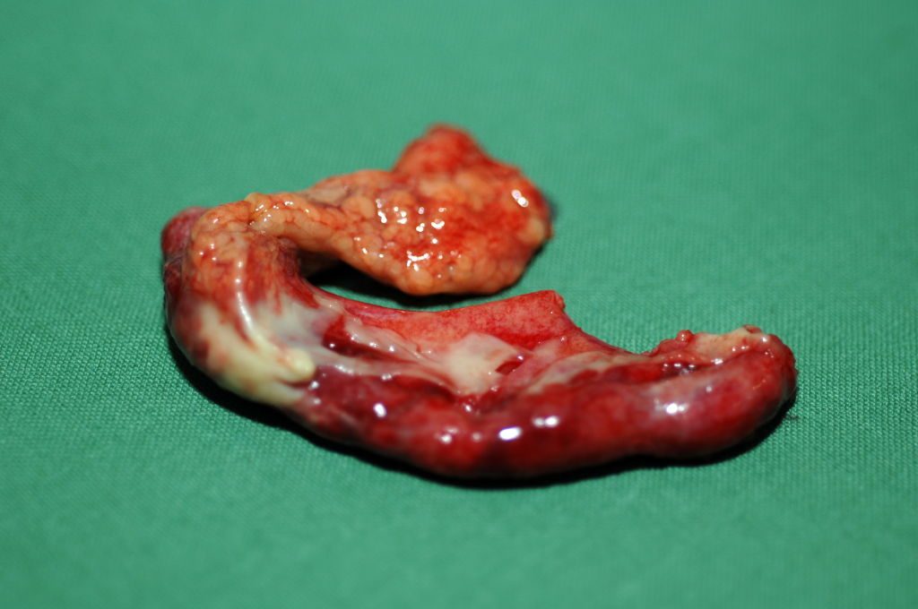 Appendix Which Has Become Inflamed.