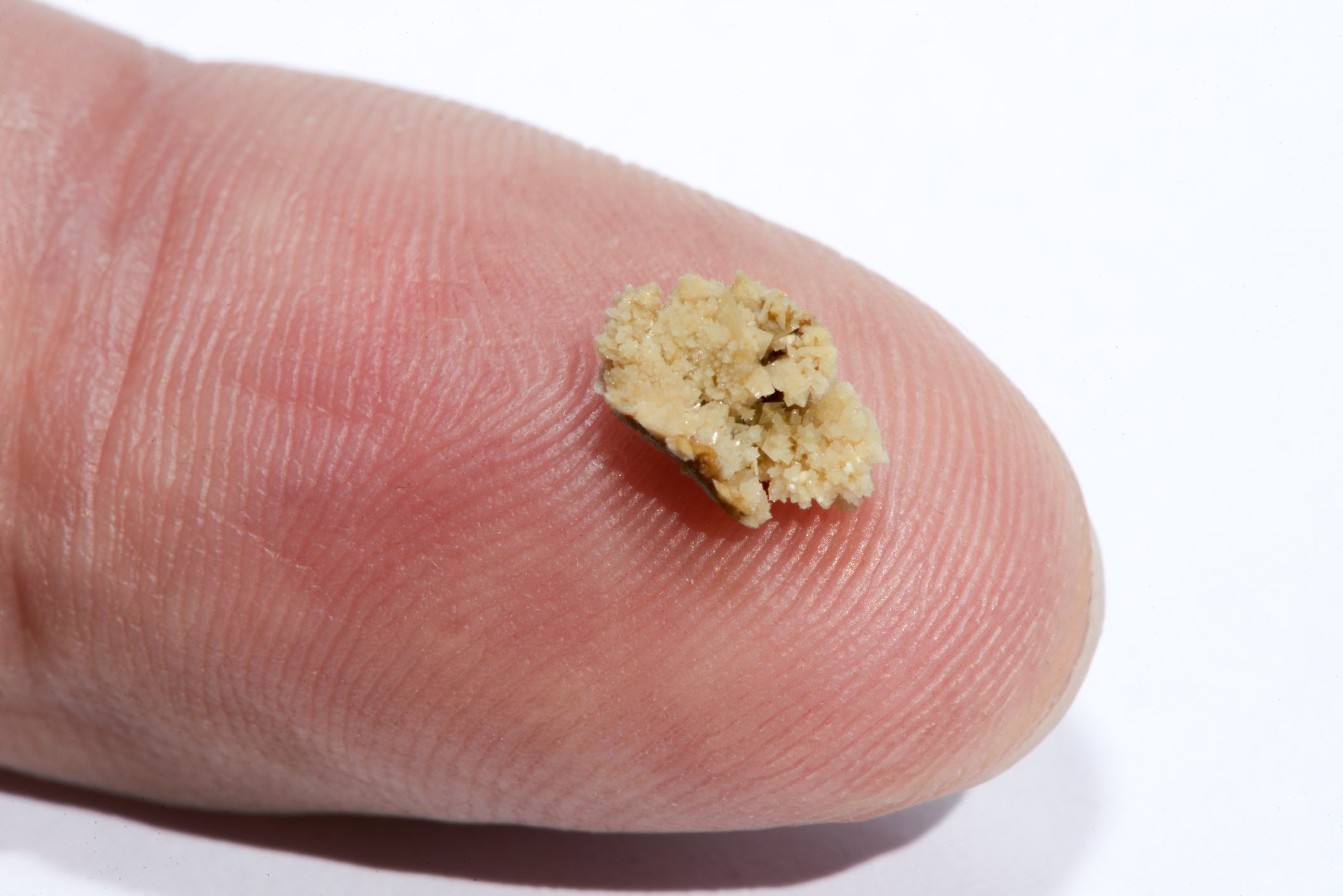 “Here’s How I Knew I Had a Kidney Stone”: A Patient’s Story
