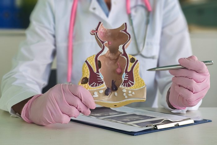 doctor holding a model of lower rectum
